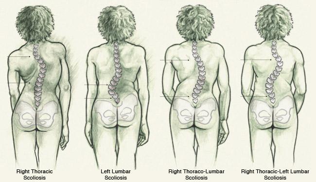 最新脊柱側(cè)彎治療方法及其奇妙之旅