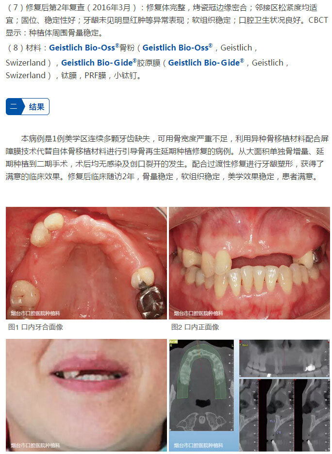 最新再生牙技術(shù)，笑迎人生，勇敢追求學(xué)習(xí)與變化的力量